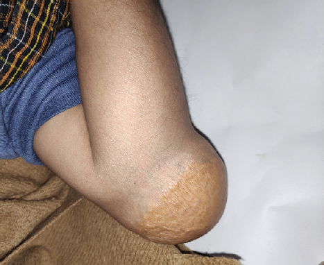 Xanthomas over the left elbow joint (lateral view).